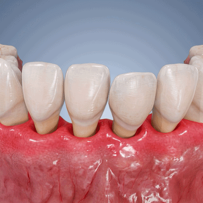 Animated periodontal and gum-line illustration